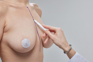Breast Augmentation. Closeup Beautician Hands In Gloves Drawing Surgical Lines On Beautiful Woman...