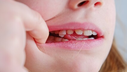 Caucasian Girl Pushing Loose Primary Deciduous Baby Tooth With Tongue
