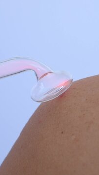 Vertical video. The doctor uses the darsonval apparatus against acne on the shoulder of a female patient.