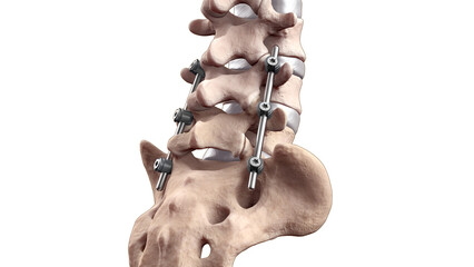 Posterior Lumbar Fusion with Pedicle Screws and Rods - obrazy, fototapety, plakaty