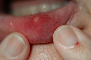 Painful close up of a mouth canker sore ulcer with a shallow depth of field and copy space