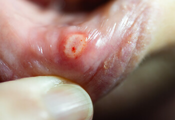 Painful close up of a mouth canker sore ulcer with a shallow depth of field and copy space - obrazy, fototapety, plakaty