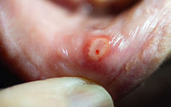 Painful close up of a mouth canker sore ulcer with a shallow depth of field and copy space