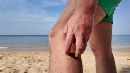 Person clutching their leg on a sandy beach, with beach fly bites, beach flea bites, possibly experiencing muscle cramp or injury, with calm sea and blue sky in the background