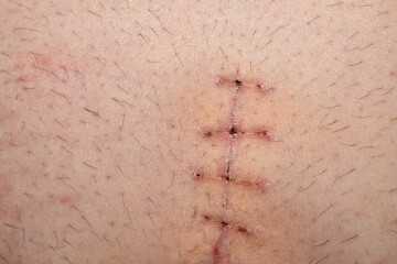 View of a postoperative suture on a mans abdomen after removal of the threads.
