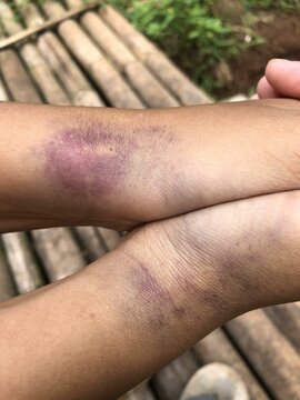 Intense blue-black bruise on hand, result of infusion needle error. Medical mishaps series. Suitable for healthcare, pain management, and recovery visuals. High-quality stock photo