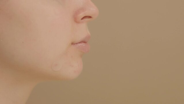 Young woman applies a round patch to a pimple on her face. Concept of the solution for acne problems. Close-up of face of unrecognizable woman on beige background, copy space.