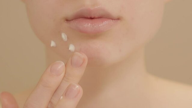 Young woman applies an anti-acne spot cream to pimples on her face. Extreme close-up of a female chin with skin acne imperfections. Woman demonstrates the application of a treatment cream.
