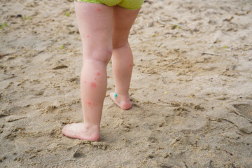 Close-up of children's bare feet, a child walking on the sand. Acne, mosquito bites, allergies.