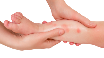 Toddler baby skin care, allergies and dermatitis, isolated on white background. A mother woman smears red spots of allergy and atopic dermatitis on the child skin with cream