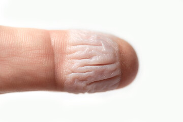 Distorted skin on a human finger after a chemical burn.