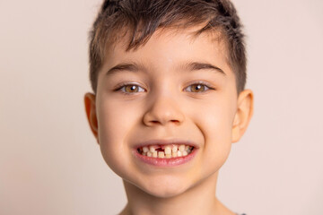 cute preschool boy with one milk teeth missing.smiling child close up face. Loss of primary teeth, replacement with permanent ones. Children's dentistry concept.