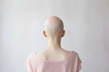 Foto op Canvas Back view of bald woman with medical condition causing hair loss like Alopecia Areata or chemotherapy © Firn