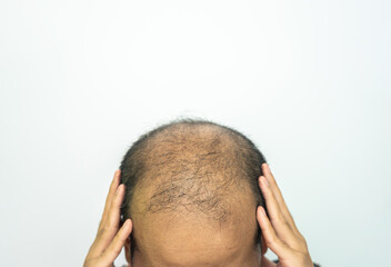 Asian man having stress cause of baldness problem. Baldness is related to your genes and male sex hormones. It usually follows a pattern of receding hairline and hair thinning on the crown. - obrazy, fototapety, plakaty