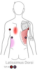 Latissimus Dorsi: Myofascial trigger points and associated pain locations
