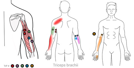 Triceps brachii: Myofascial trigger points and associated pain locations - obrazy, fototapety, plakaty
