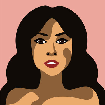 Beautiful young woman with vitiligo skin disease vector image in minimalistic style with brown eyes