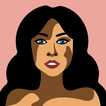 Beautiful young woman with skin disease vitiligo vector image in minimalistic style brunette