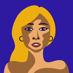 Young woman with skin disease vitiligo with European appearance in minimalist style