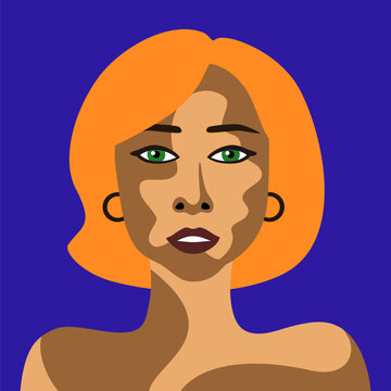 Red-haired young woman with skin disease vitiligo vector image in minimalistic style