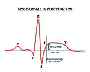 Myocardial infraction ECG with abnormal ST segment elevation outline diagram. Labeled educational scheme with medical example of heart rate abnormality vector illustration. Heart pulse cardiac issue. - obrazy, fototapety, plakaty