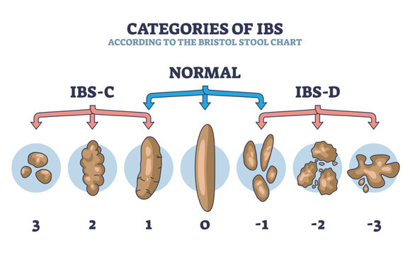 Categories of IBS stages according to bristol stool chart outline diagram. Labeled educational scheme with normal and abnormal excrement structures vector illustration. Digestive health conditions.