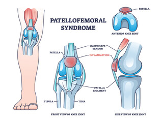Patellofemoral pain syndrome as anatomical knee condition outline diagram. Labeled educational scheme with leg kneecap patella part inflammation vector illustration. Joint quadriceps tendon location - obrazy, fototapety, plakaty