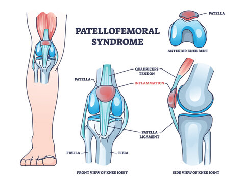 Patellofemoral pain syndrome as anatomical knee condition outline diagram. Labeled educational scheme with leg kneecap patella part inflammation vector illustration. Joint quadriceps tendon location