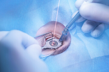 Process laser vision correction, lasik treatment. Doctor use equipment for fixing eyeball, patient under sterile cover