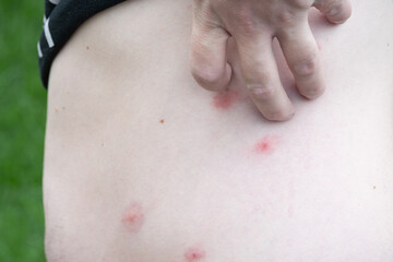 Naklejka premium Bites on the skin of a man.