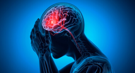 Man with a headache - Brain Stroke - 3D Illustration - 707996151