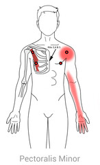 Pectoralis Minor Pain: Myofascial trigger points and associated pain locations