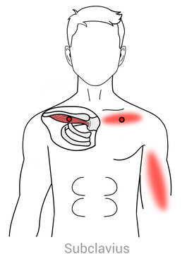 Subclavius: Myofascial trigger points and associated pain locations