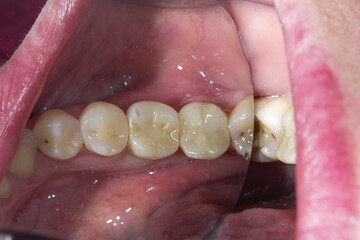 Obraz premium Close-up photo in dentist office. Dental examination of the patient with dental mirror.