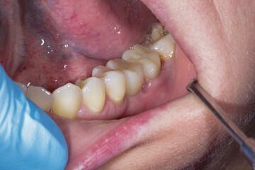 Close-up photo in dentist office. Dental examination of the patient with dental mirror.