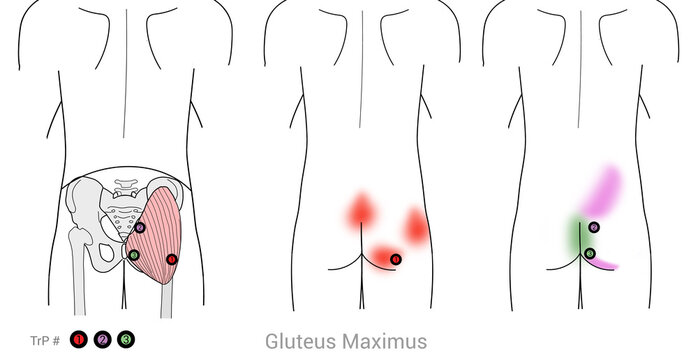 Gluteus Maximus: Myofascial trigger points and associated pain locations