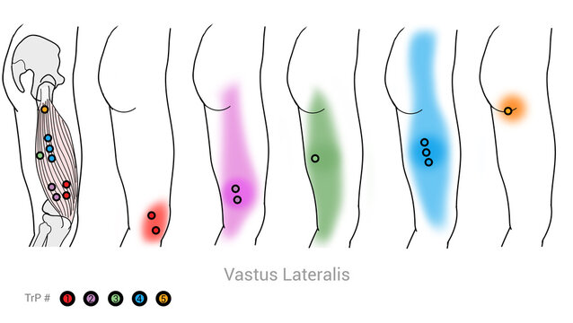 Quadriceps ,Vastus Lateralis: Myofascial trigger points and associated pain locations
