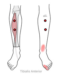 Tibialis Anterior: Myofascial trigger points and associated pain locations