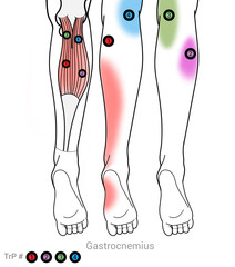 Gastocnemius: Myofascial trigger points and associated pain locations