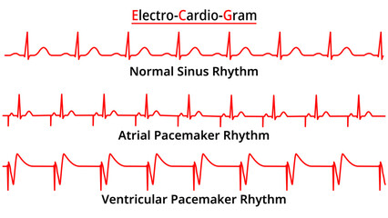Set of ECG Common Abnormalities - Atrial vs Ventricular Pacemaker Rhythm - Single Chamber - Electrocardiogram Vector Medical Illustration - obrazy, fototapety, plakaty