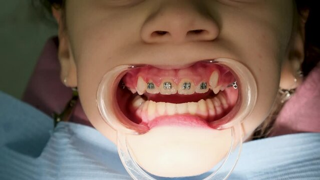 Close-up of a girl's mouth with a retractor in place. A dentist puts braces on the teeth of a young girl child.