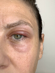 Closeup female patient's infected eye