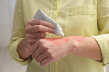 Woman applying healing cream onto burned hand indoors, closeup