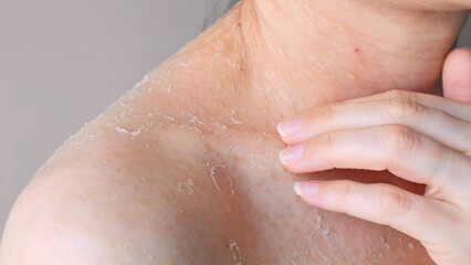 Peeling skin close-up skin problems on shoulder scratching shoulder front view until peeling,...