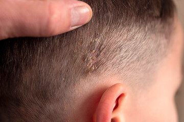 Host formation on the scalp of the head in children, host disease on the scalp,