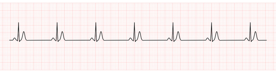 EKG Monitor Showing  Sinus Rhythm with Short QT interval