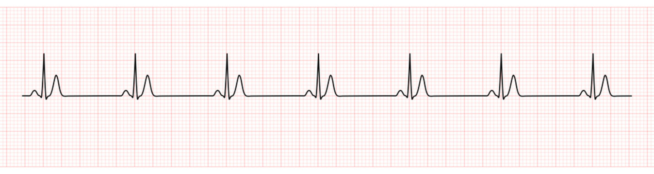 EKG Monitor Showing  Sinus Rhythm with Short QT interval