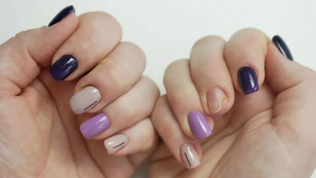 Women's hands with a beautiful manicure and a fungal nail disease finger with pus next to the nail paronychia disease. Partial absence of a nail.