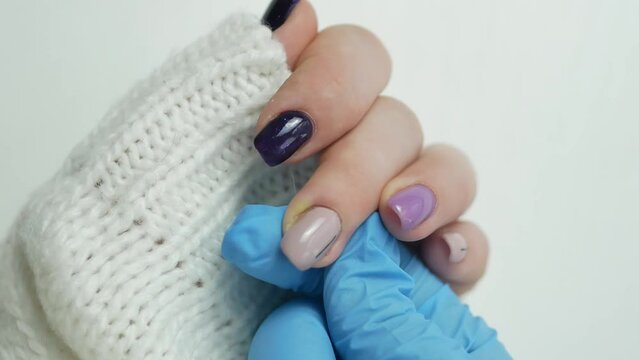 A doctor in a rubber glove touches a finger with a purulent abscess of the patient. Paronychia is an inflammation of the periarticular roller. Treatment of dermatological inflammations.