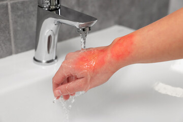 Woman holding burned hand under cold water indoors, closeup